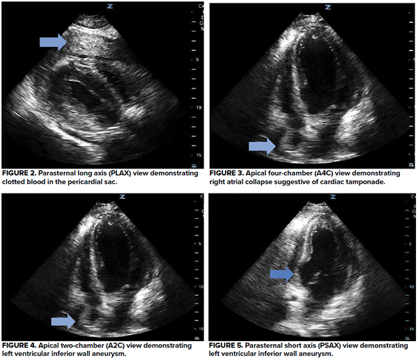 Pointofcare Echocardiography in the Undifferentiated Patient A Case