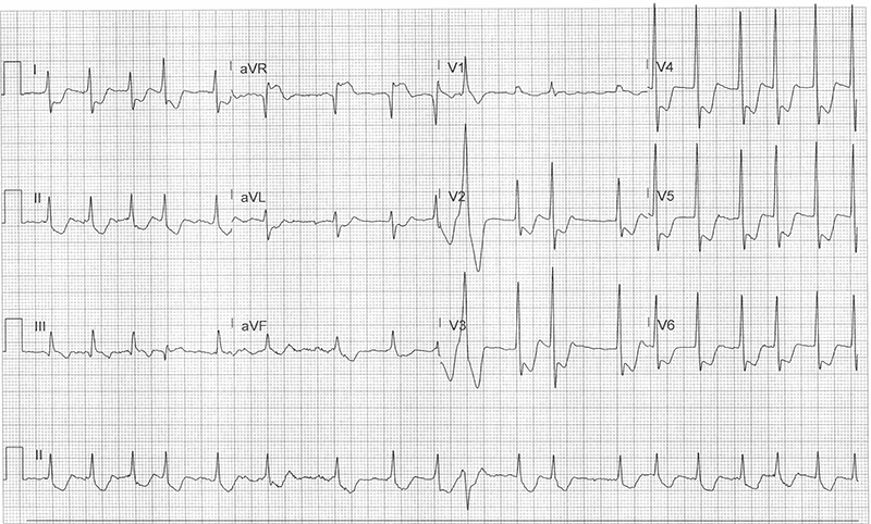 49-1 ECG Challenge - Initial EKG.png