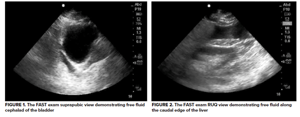 Not so FAST: Intraperitoneal Bladder Rupture EMRA