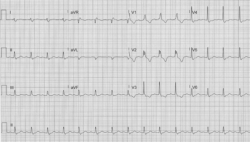 49-2 ECG Challenge - Fig 1- RBBB normal copy.jpg