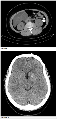 49-2 Gallbladder Hematoma Fig 1-2.png