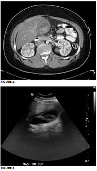 49-2 Gallbladder Hematoma Fig 3-4.png