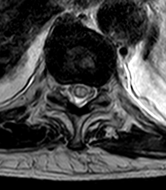 Spinal Cord Ischemia - AxialT2-OWL-EYES.jpeg