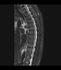 Spinal Cord Ischemia - Sagittal STIR.jpeg