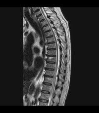 Spinal Cord Ischemia - Sagittal T2.jpeg