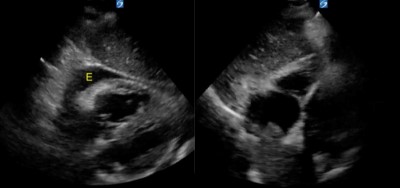 Ultrasound Pericardiocentesis.jpg