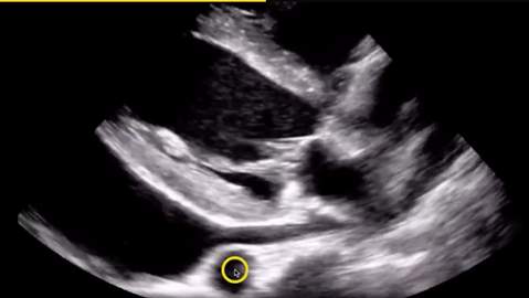 PoCUS Ultrasound Pitfall
