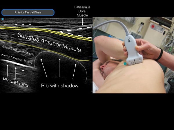 16 - US Guided Nerve Blocks - 006.jpeg