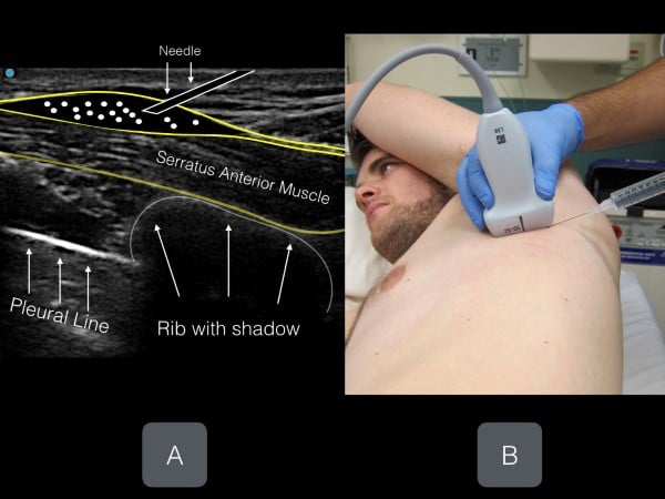 16 - US Guided Nerve Blocks - 007.jpeg