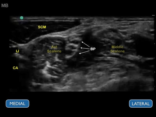 16 - US Guided Nerve Blocks - 009.jpeg