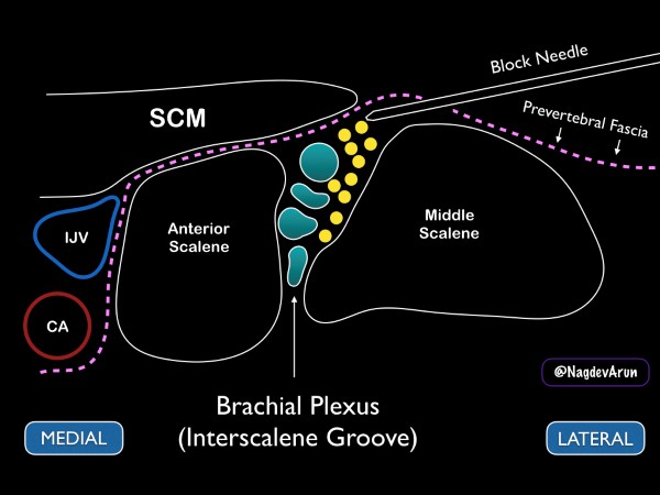 16 - US Guided Nerve Blocks - 011.jpeg