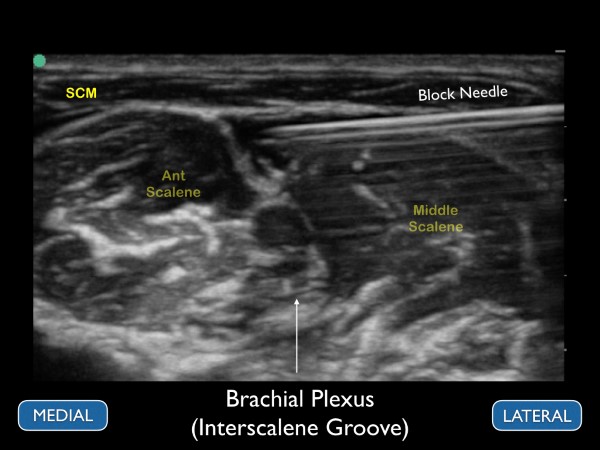 16 - US Guided Nerve Blocks - 012.jpeg