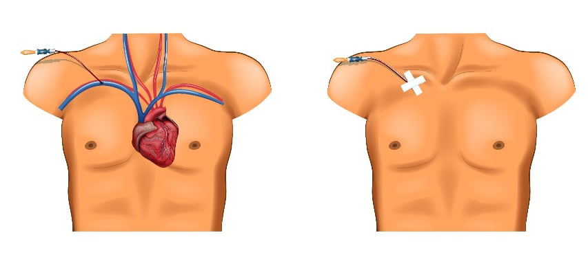 Subclavian Central Lines.jpg