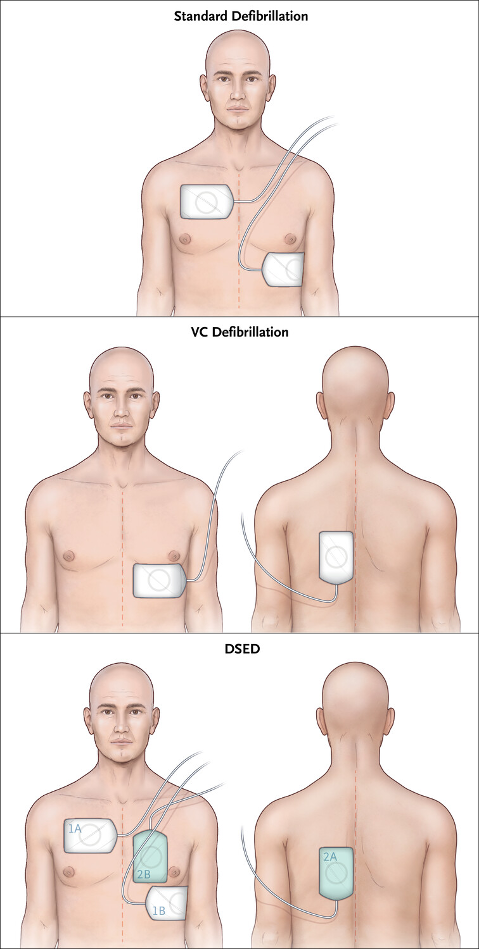 DSD Fig 1.png