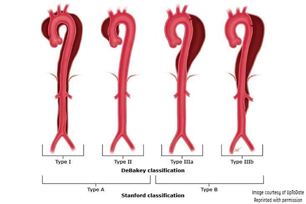 Reproduced with permission from Manning WJ, Black JH. Overview of acute aortic syndromes. In: UpToDate, Post TW (Ed), UpToDate, Waltham, MA. (Accessed on Jan. 23, 2018.) Copyright © 2018 UpToDate, Inc. For more information visit www.uptodate.com.