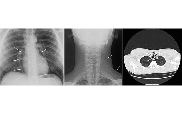 45-3_Pneumomediastinum.jpg