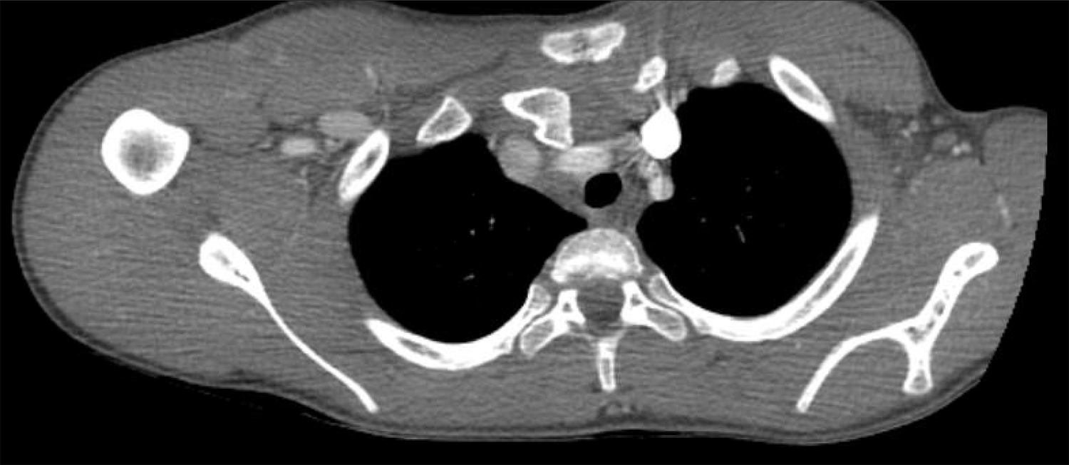 45-3_Shoulder-Sublux_ 5 - CT Chest.png