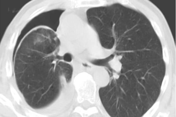 45-3_Thoracentesis.jpg