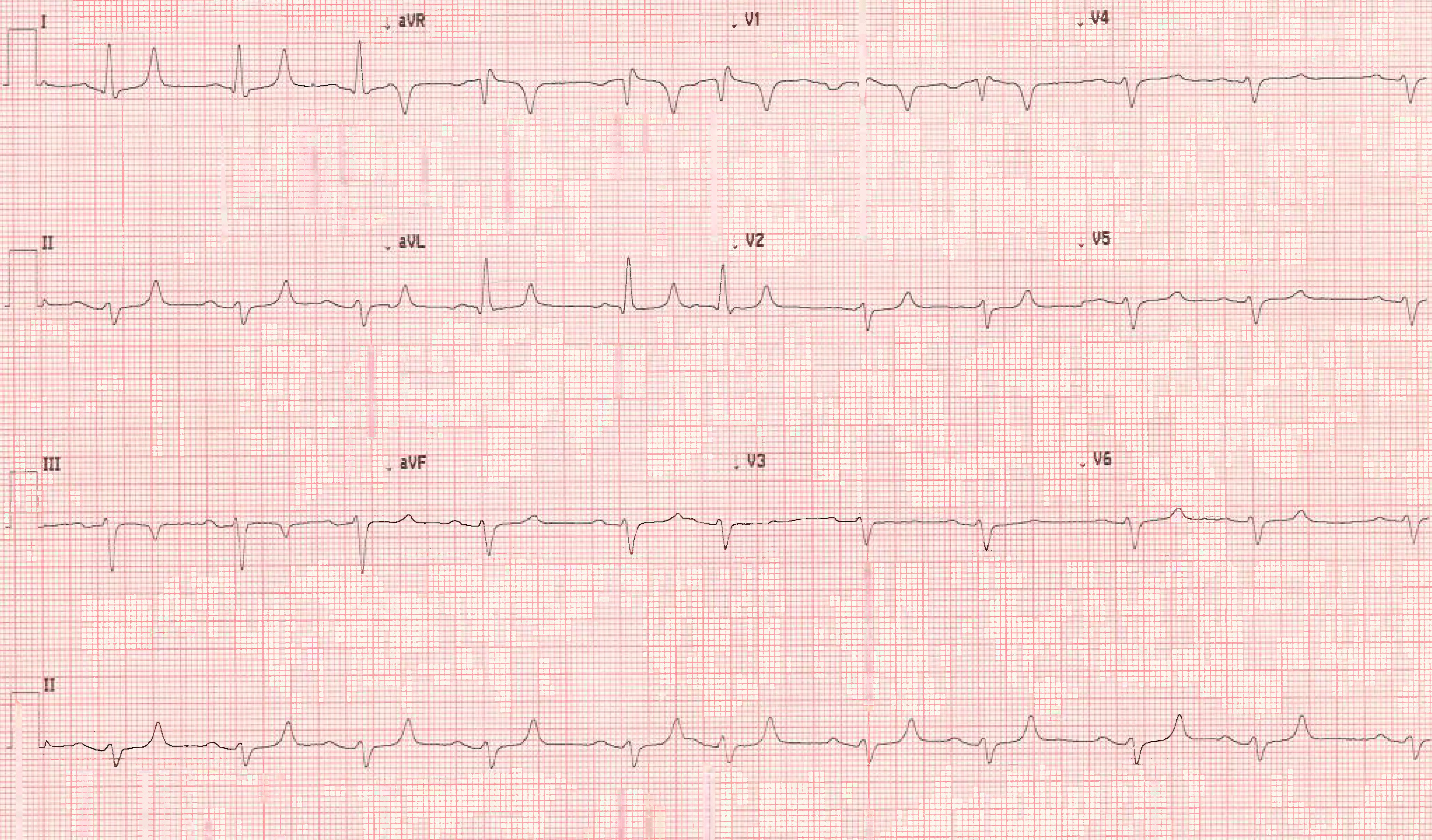 Hyperkalemia Figure 1