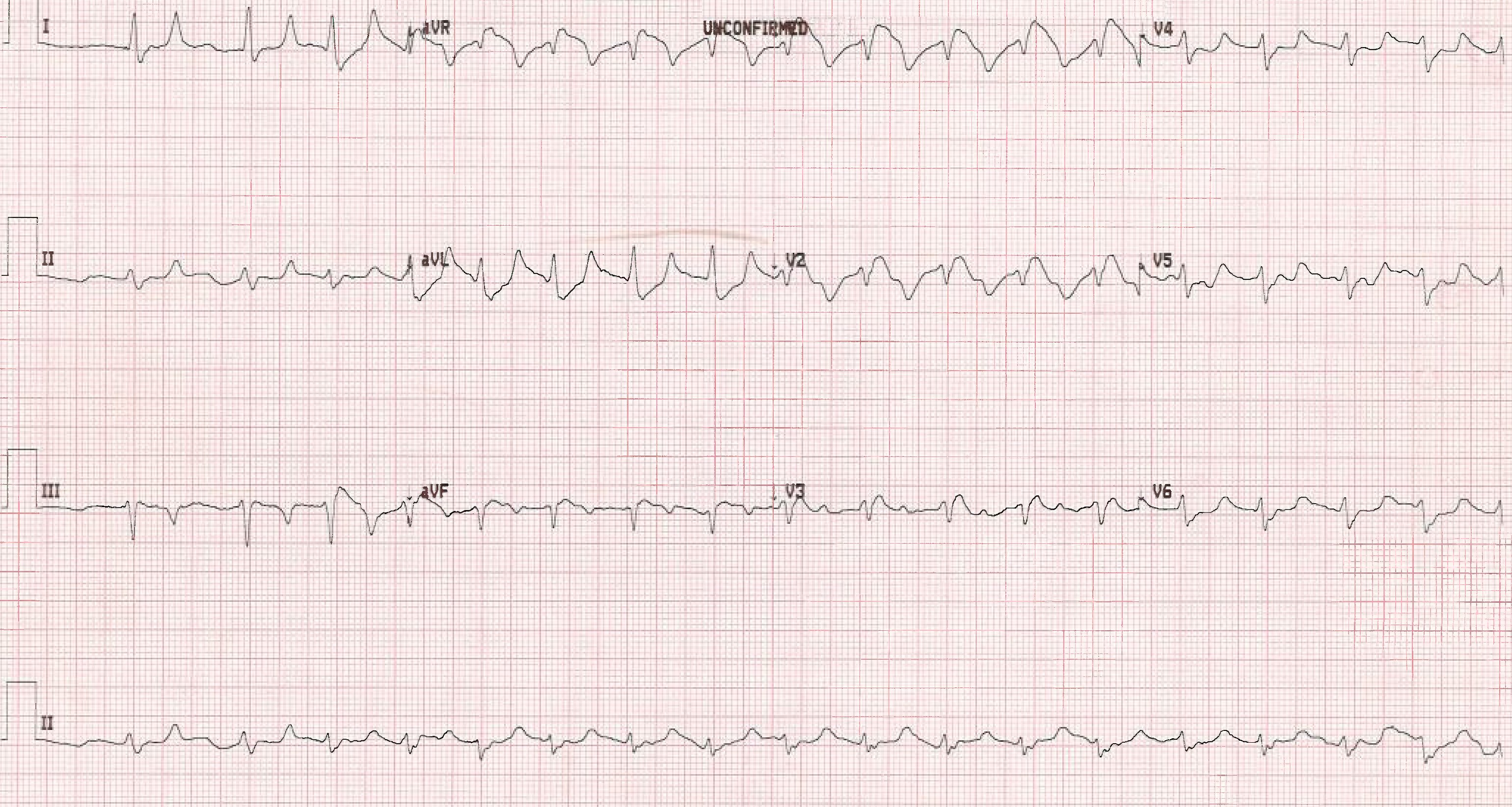 Hyperkalemia Figure 2