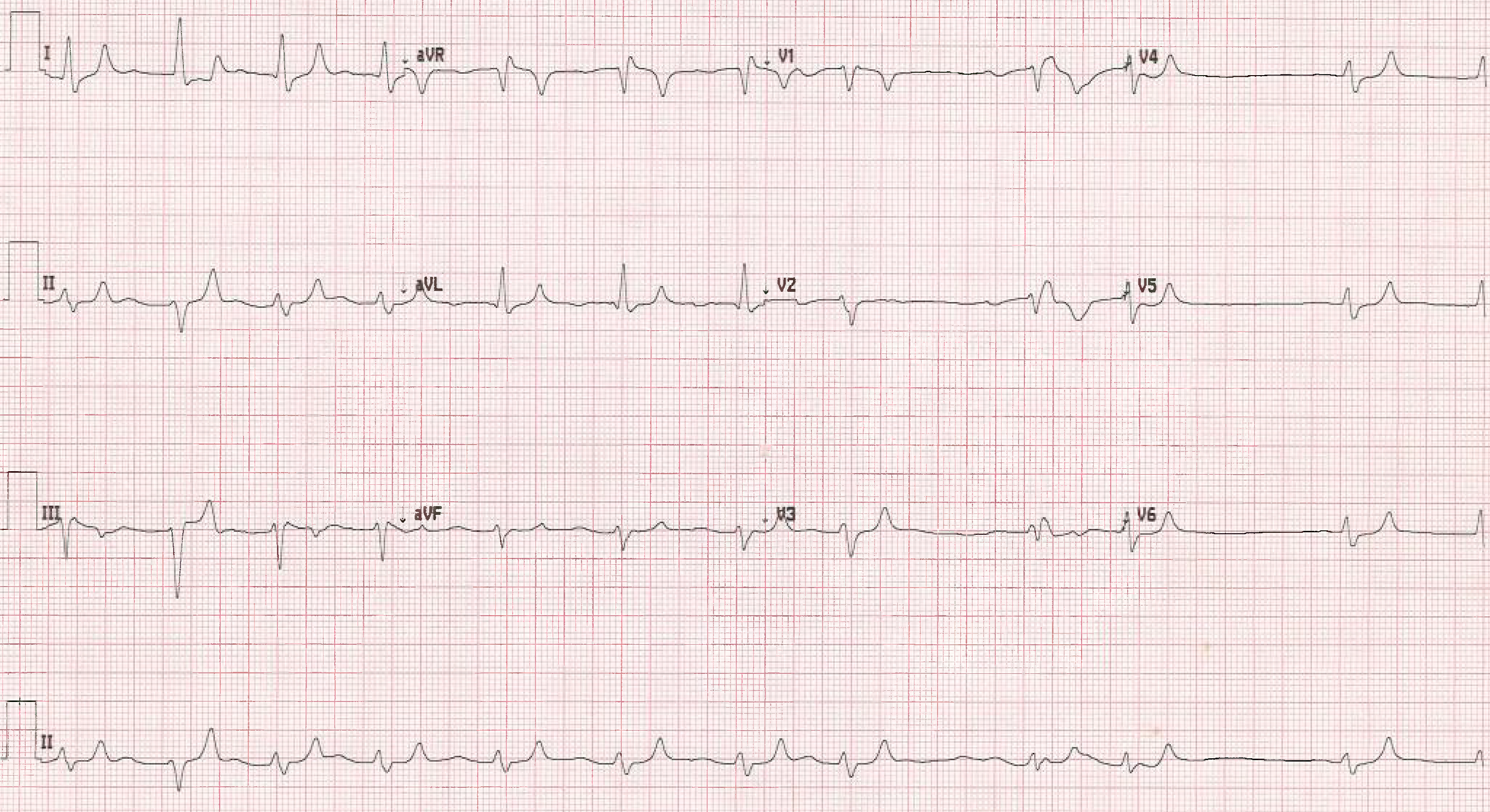 Hyperkalemia Figure 3