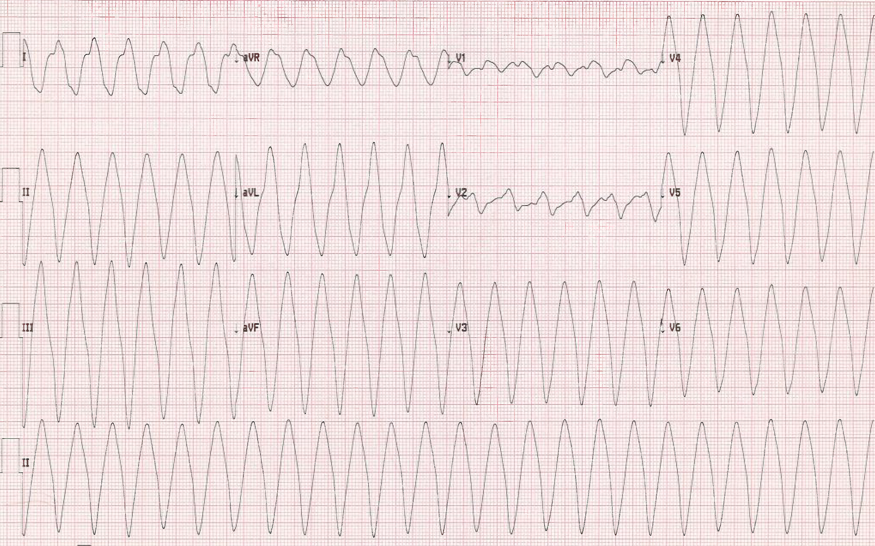 Hyperkalemia Figure 4