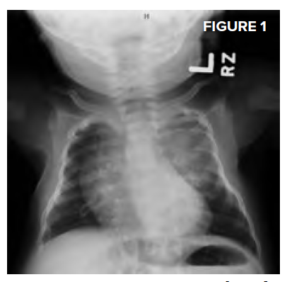 Pediatric Paralysis Figure 1