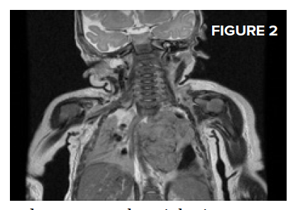 Pediatric Paralysis Figure 2