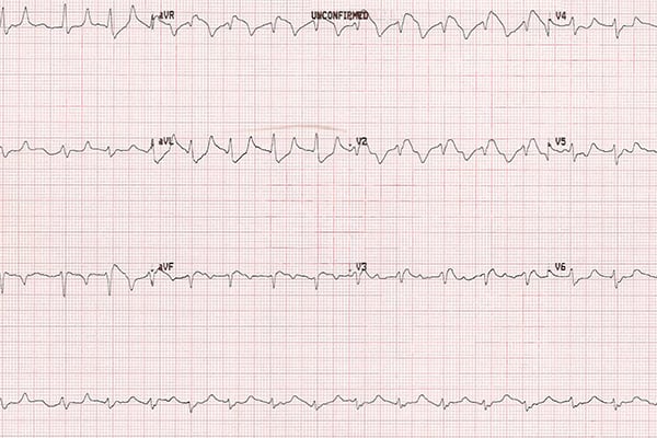 45-4_Hyperkalemia.jpg 45-4_Hyperkalemia.jpg