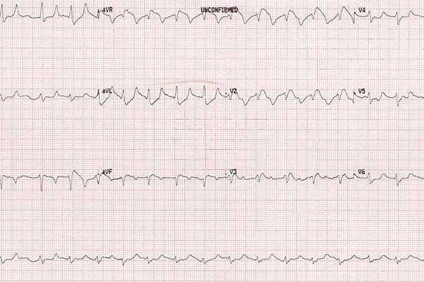 45-4_Hyperkalemia.jpg