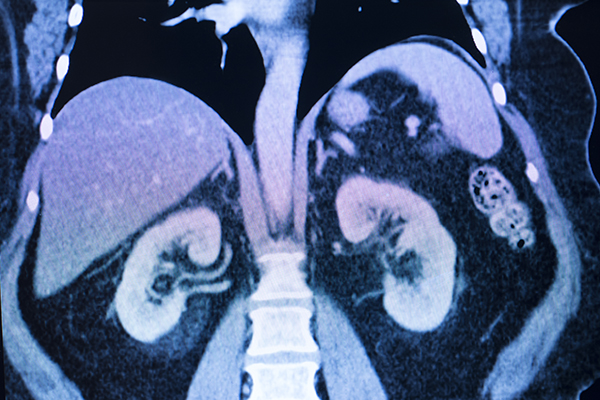 45-5 Contrast Induced Nephropathy.jpg