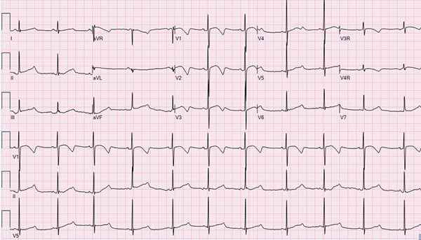 Comparing Personal EKGs: What you need to know