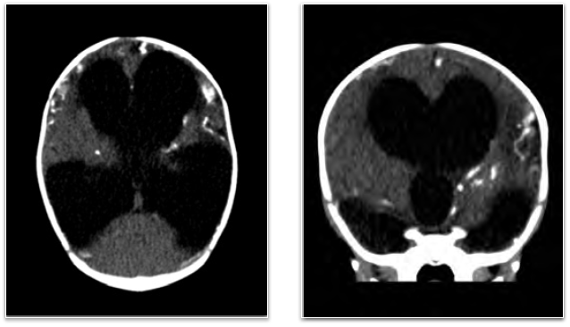 45-5 Visual Diagnosis - Congenital Toxoplasmosis.png