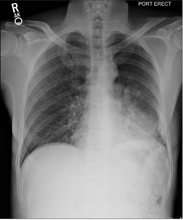 FIGURE 1. Initial CXR 