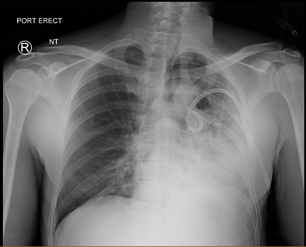 FIGURE 2. Second CXR