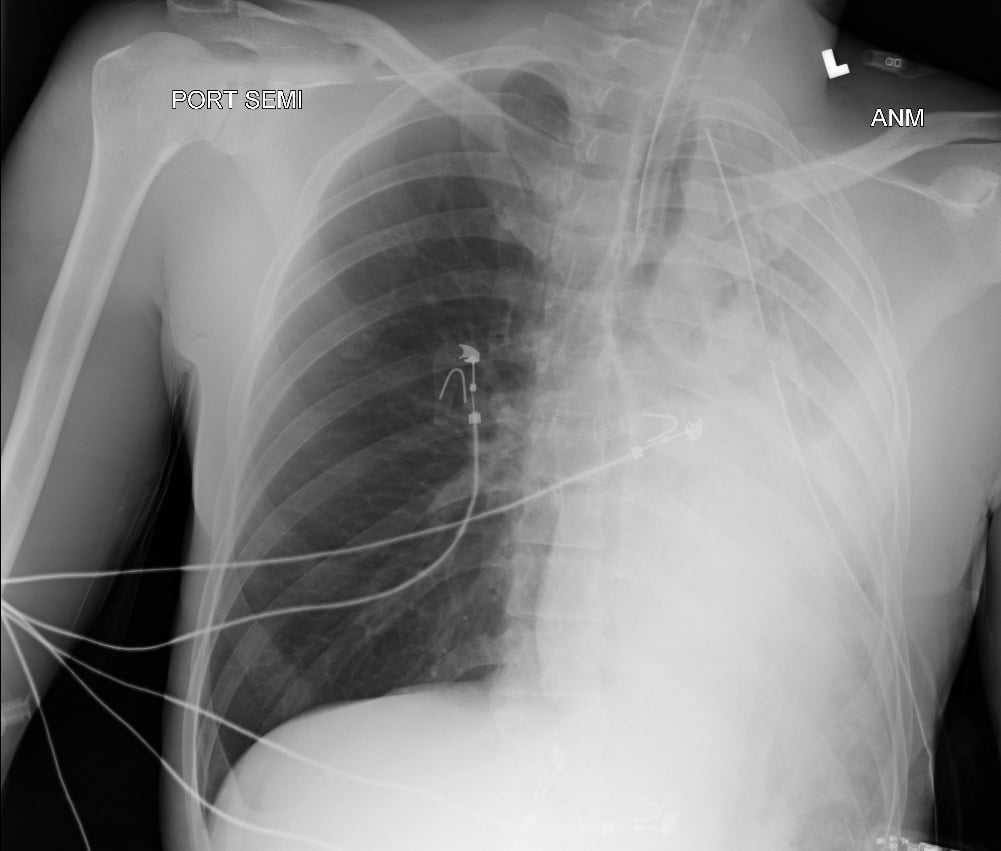 FIGURE 3. Third CXR