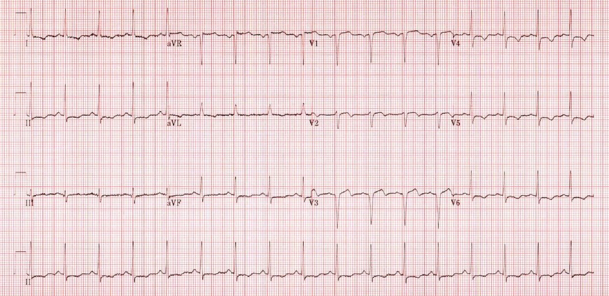 ECG Challenge: October 2018