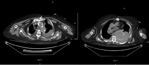 45-6 Rupturing Aortic Aneurysm.jpg