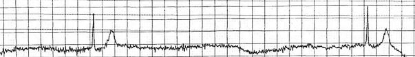 Figure 1. Pause of about 4.5 seconds