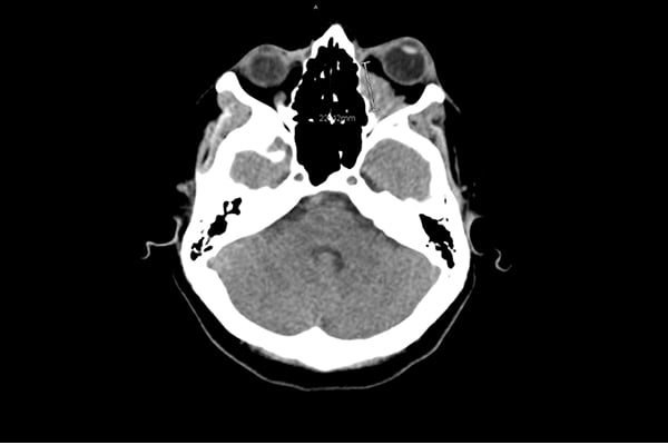 45-6 Spontaneous Proptosis.jpg