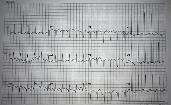 45-6 Thyrotoxicosis.jpg