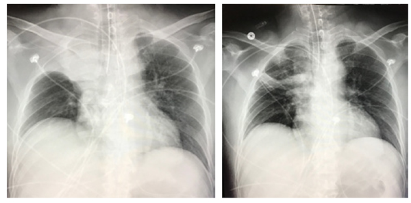 45-6 Tracheal Bronchus.jpg