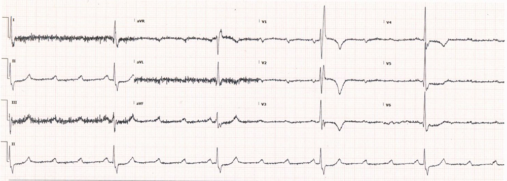 ECG Challenge Image 2