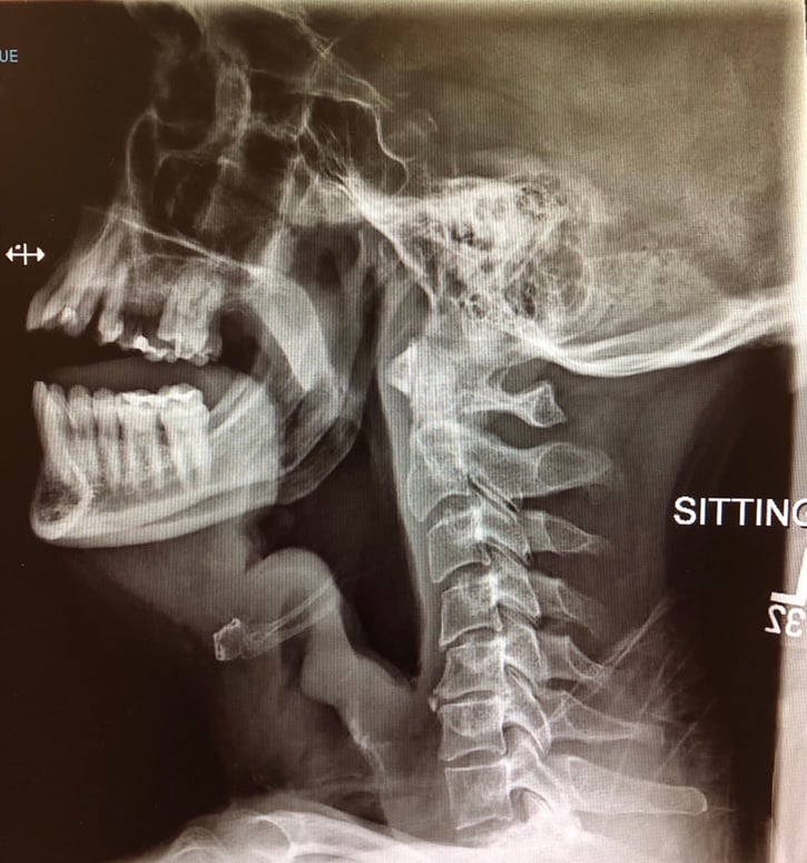 Visual Dx - Epiglottitis 2.jpg