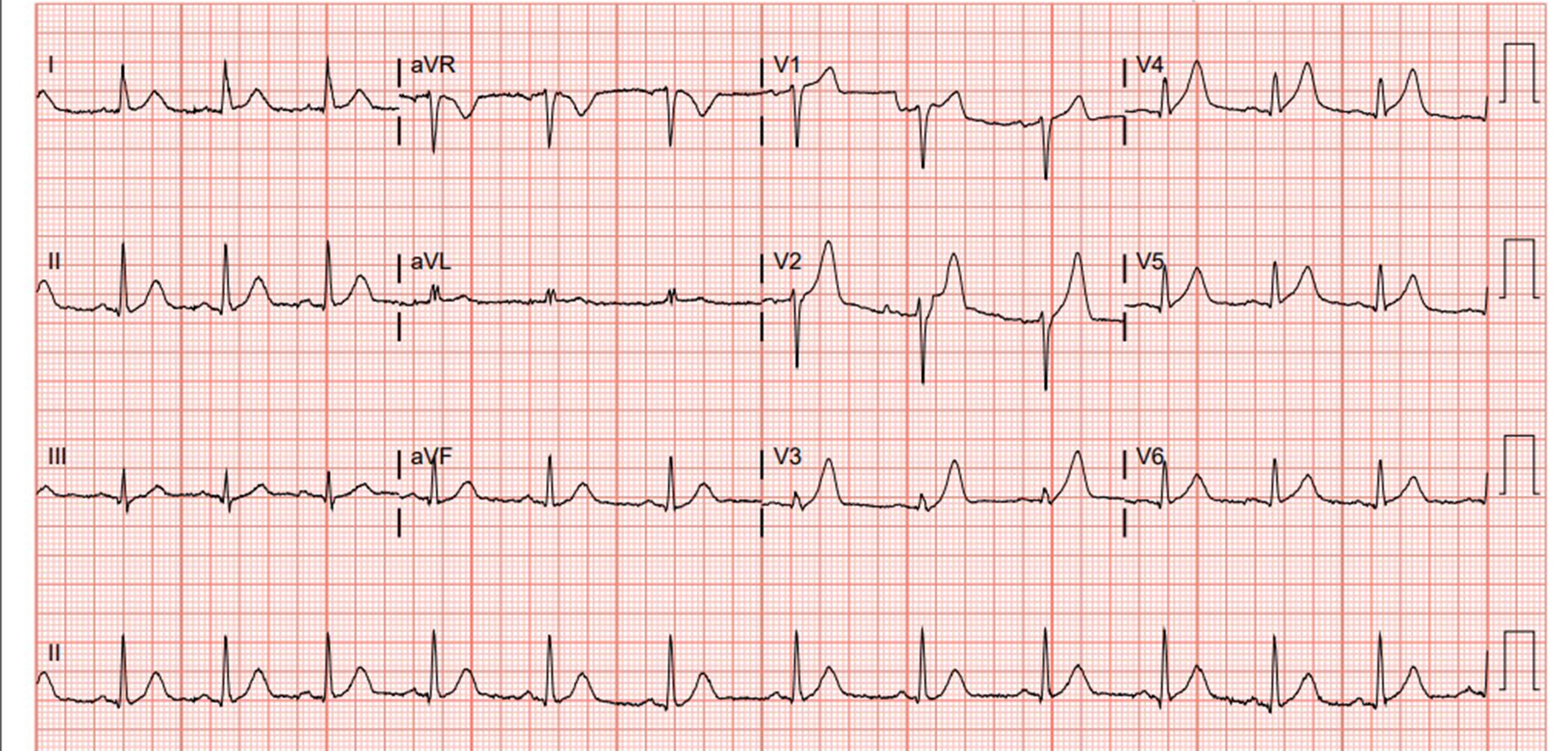 46-1 Case Report - Acute MI - EKG 1.jpg