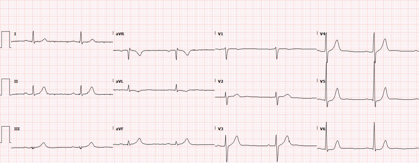 ECG