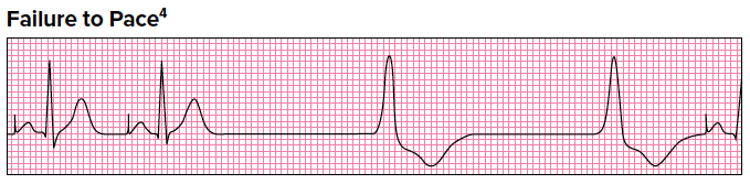 Failure to Pace