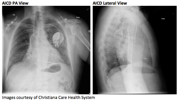 46-1 Pacemaker Basics Overview.png