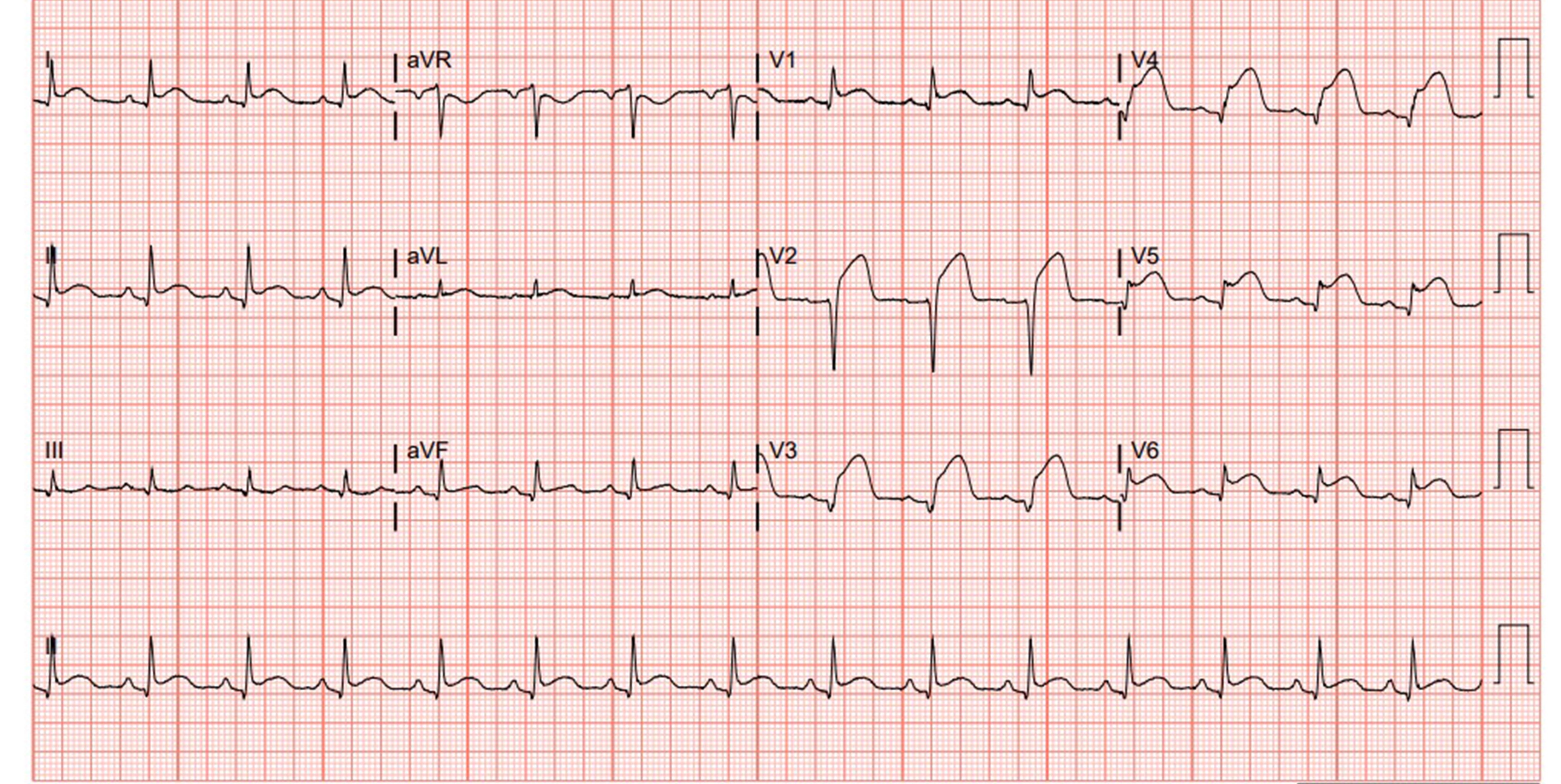 Figure 2 - Repeat EKG
