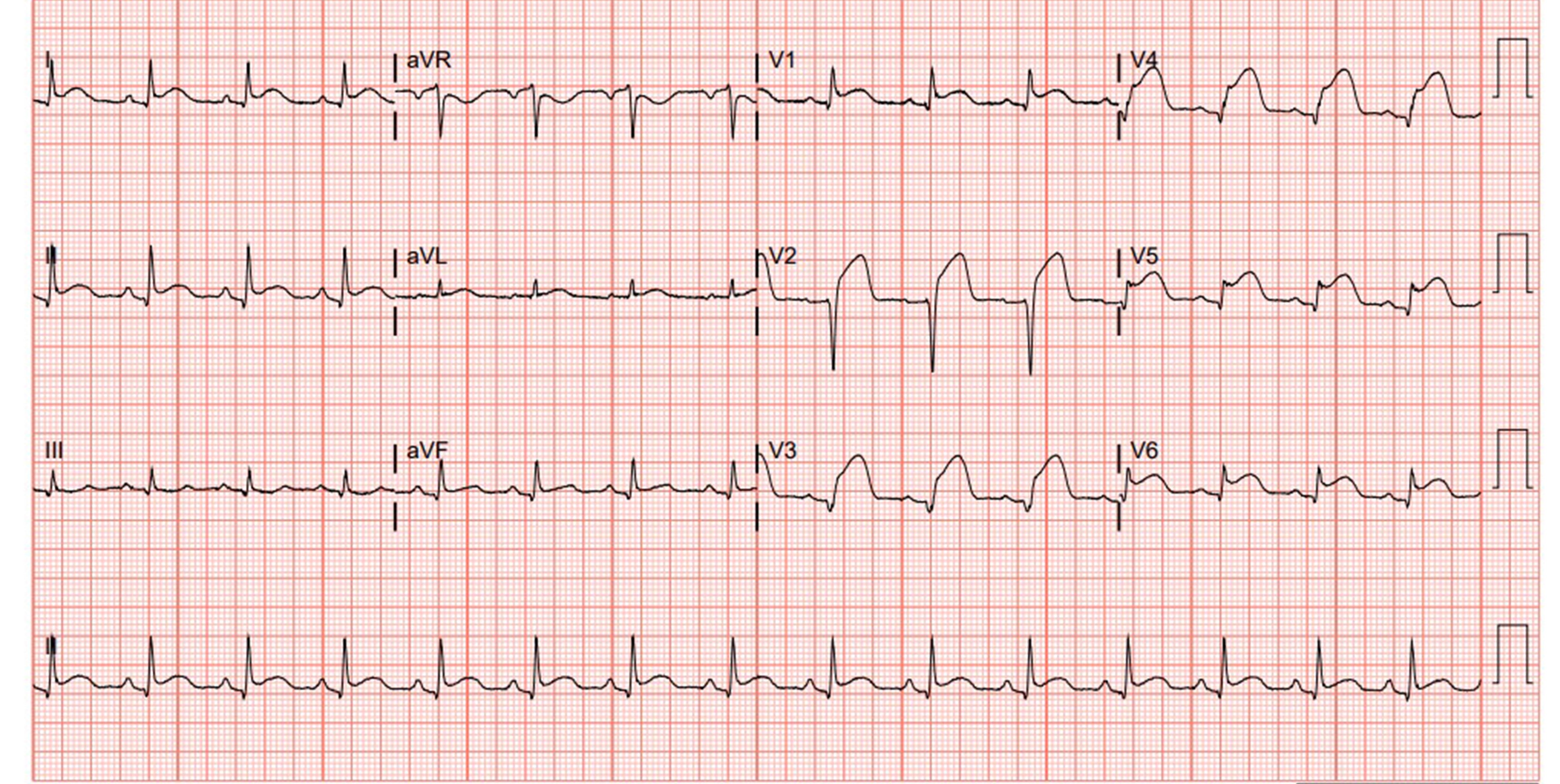 Figure 2 - Repeat EKG